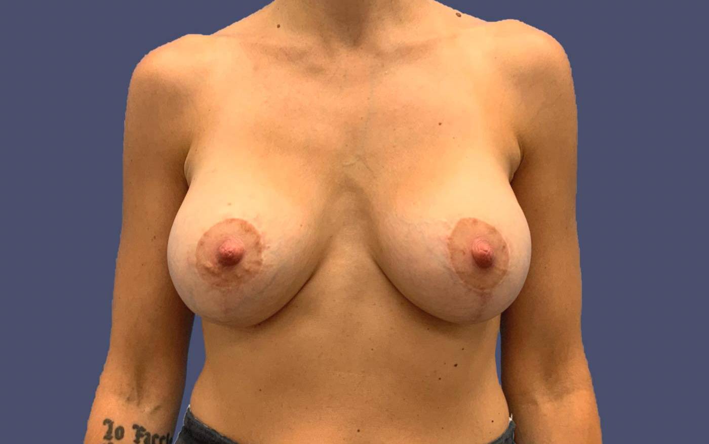 Breast Lift w/ Augmentation 6 After