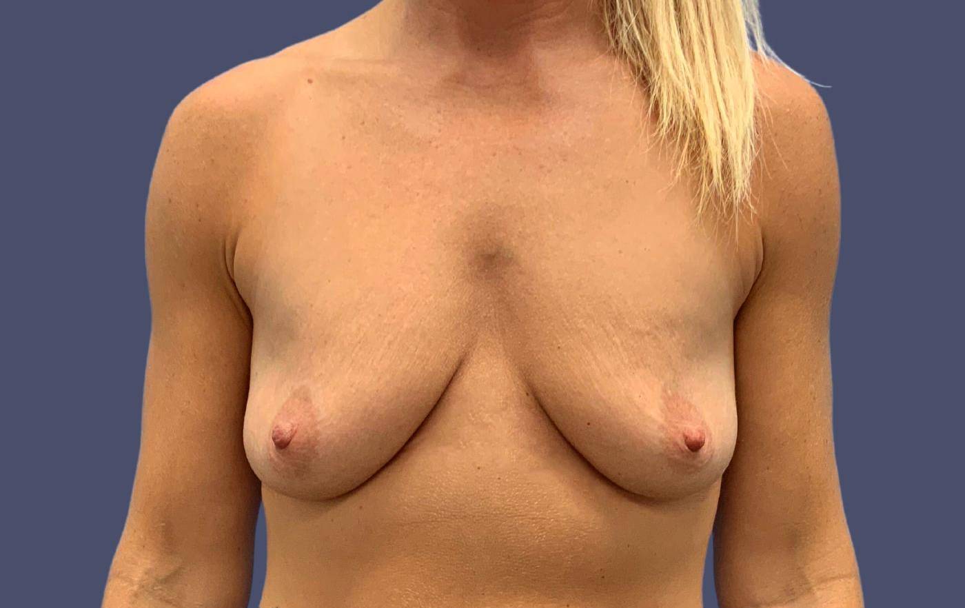 Breast Lift w/ Augmentation 8 Before