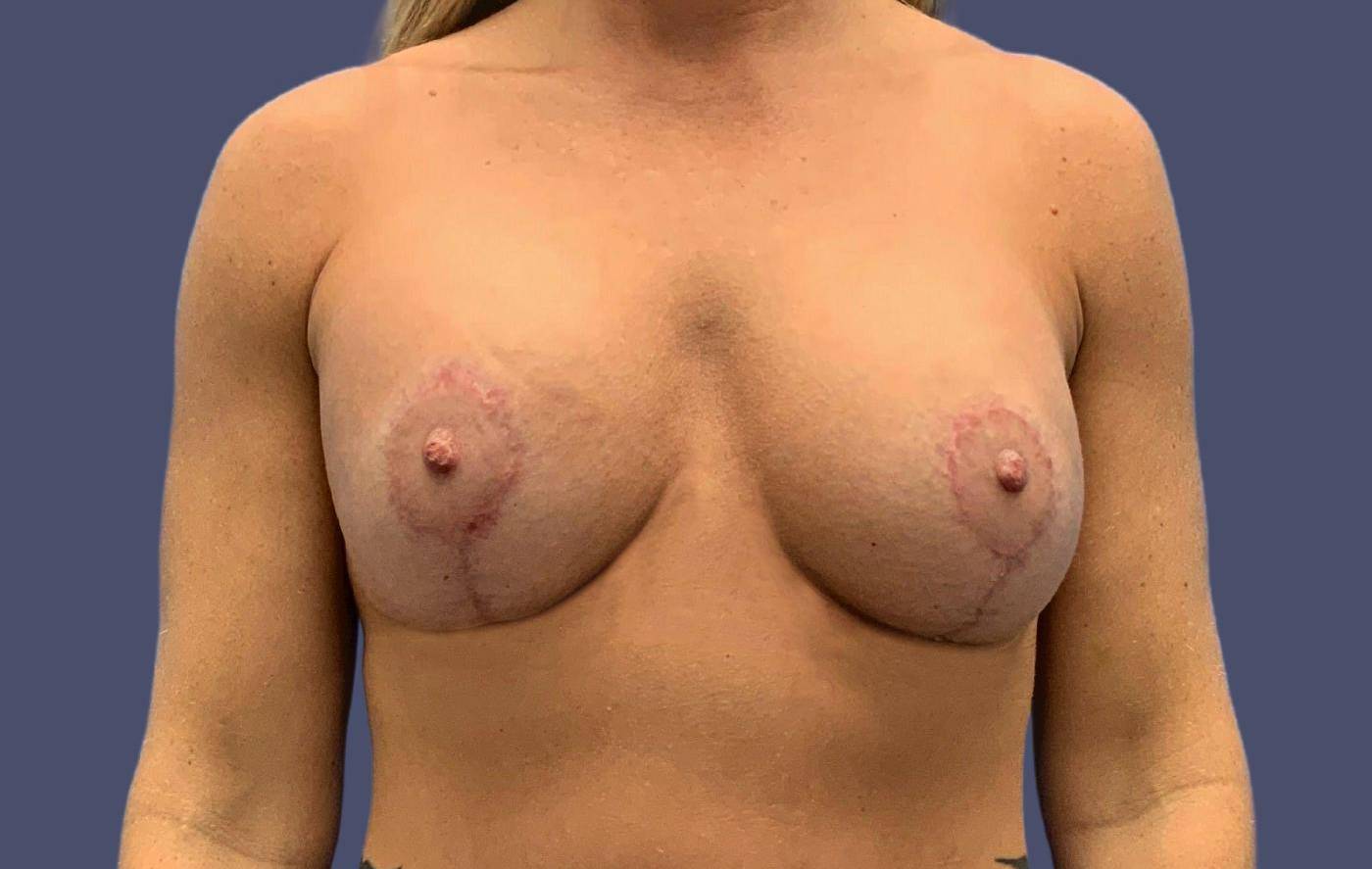Breast Lift w/ Augmentation 8 After