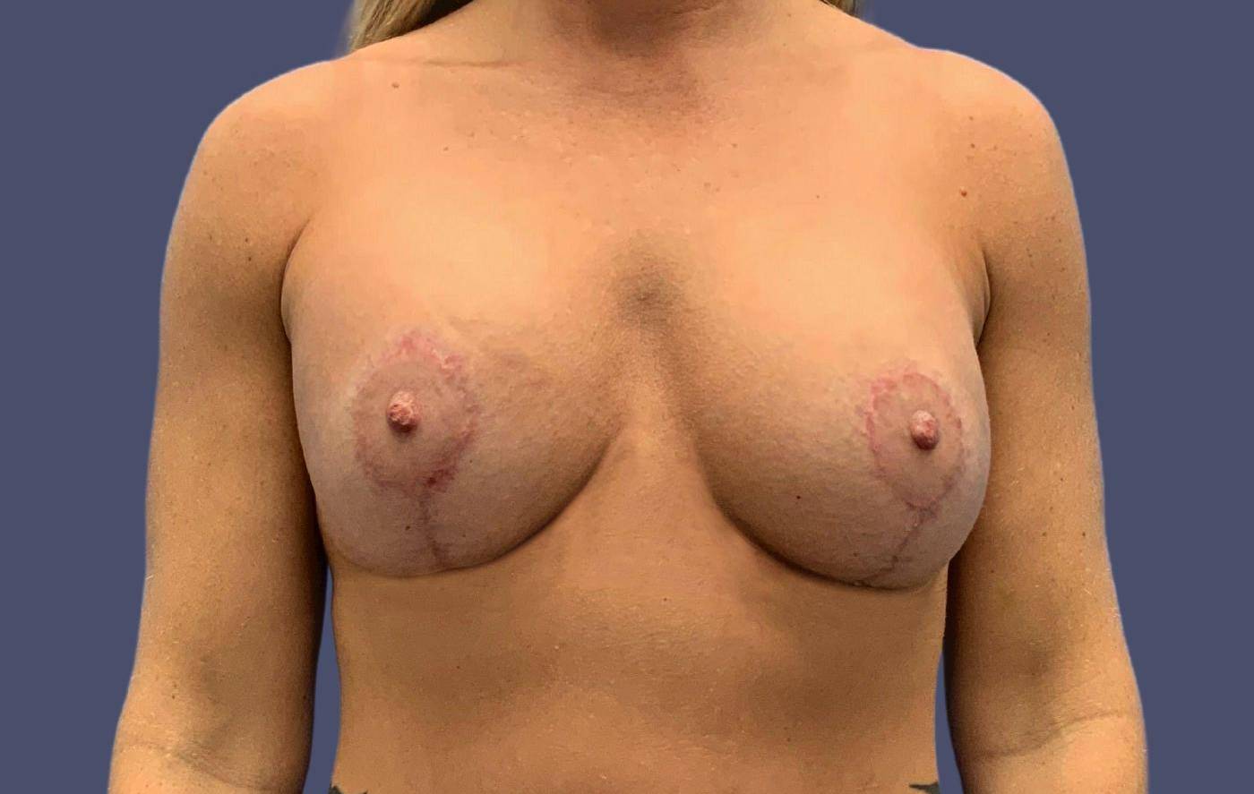 Breast Lift w/ Augmentation 10 After