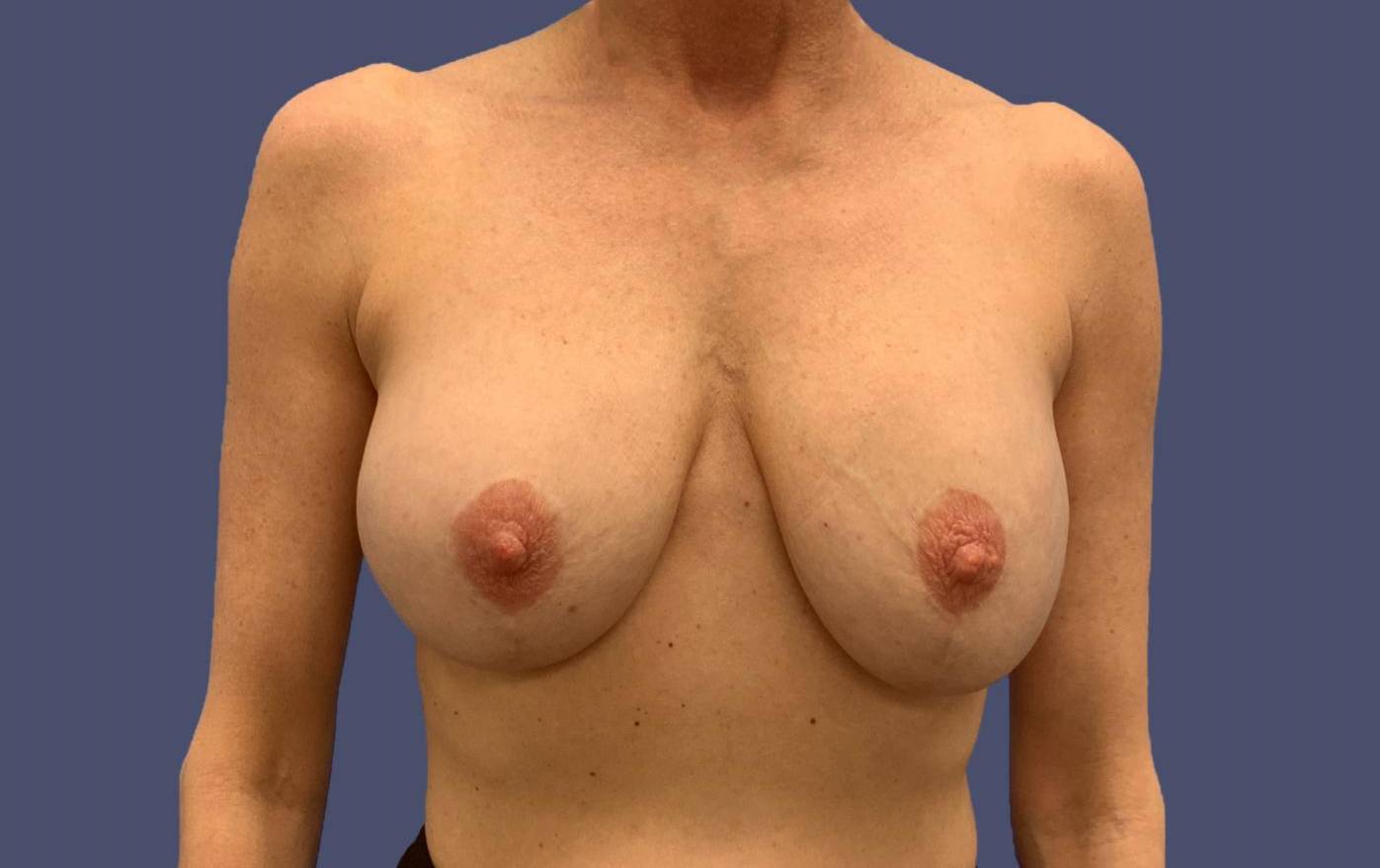 Breast Lift w/ Augmentation 20 Before