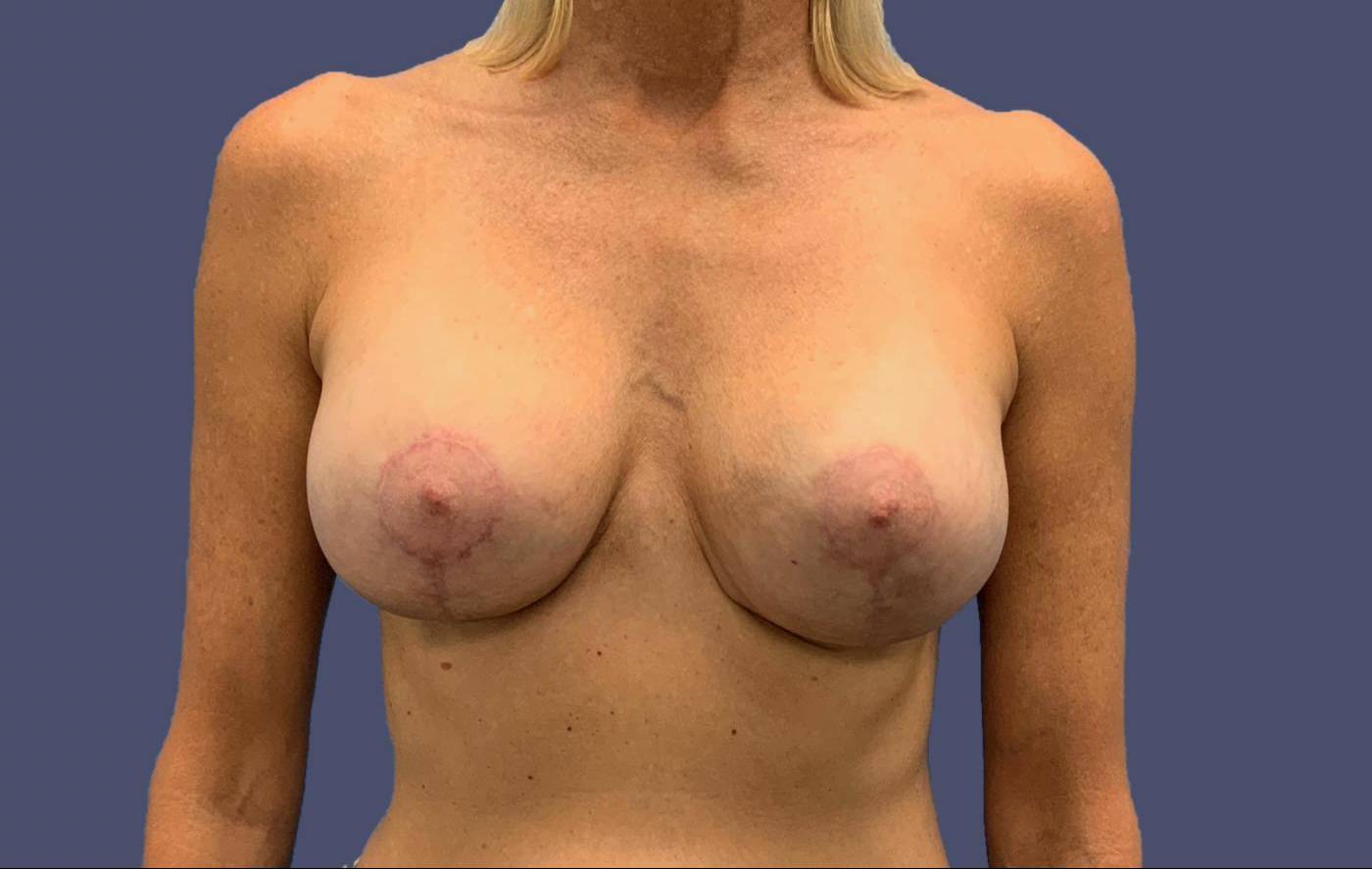 Breast Lift w/ Augmentation 11 After