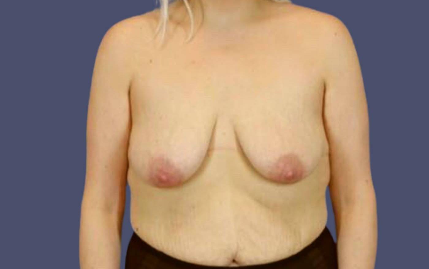 Breast Lift w/ Augmentation 21 Before