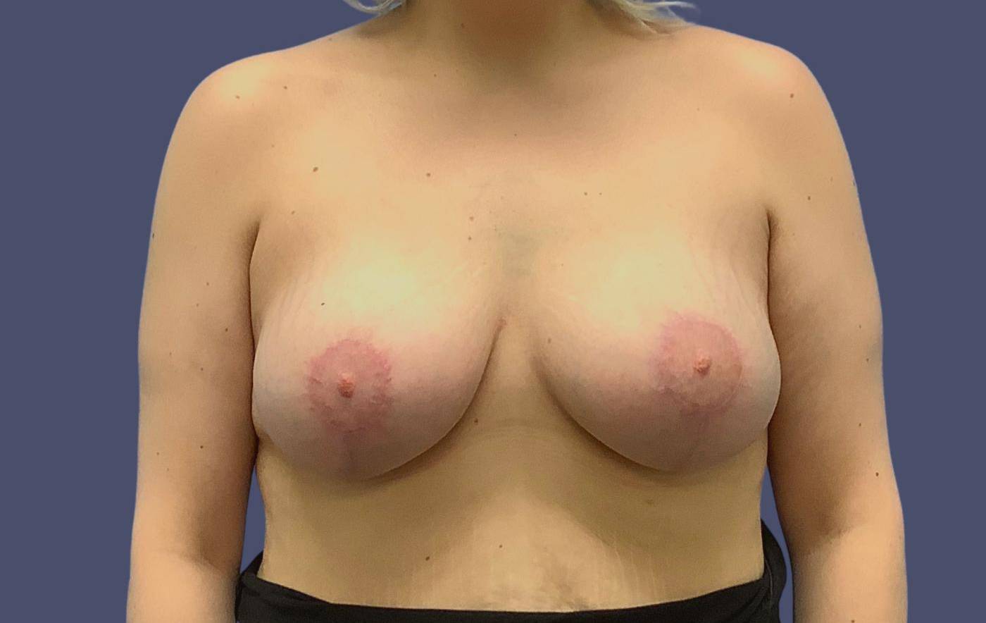 Breast Lift w/ Augmentation 17 After
