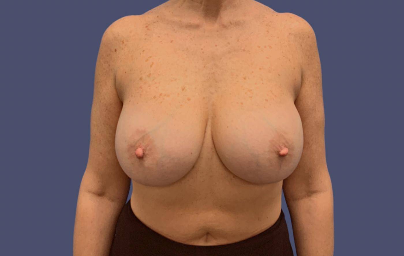 Breast Lift w/Fat Transfer 5 Before