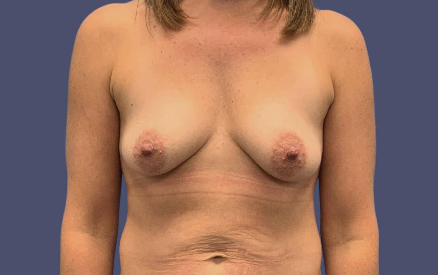 Breast Lift w/Fat Transfer 6 Before