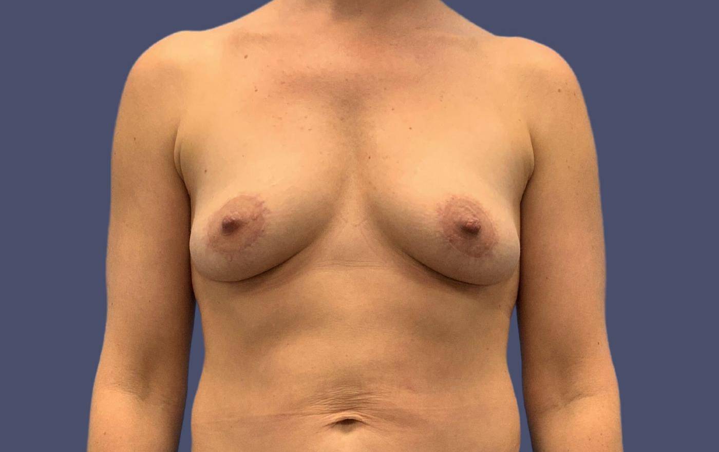 Breast Lift w/Fat Transfer 4 After