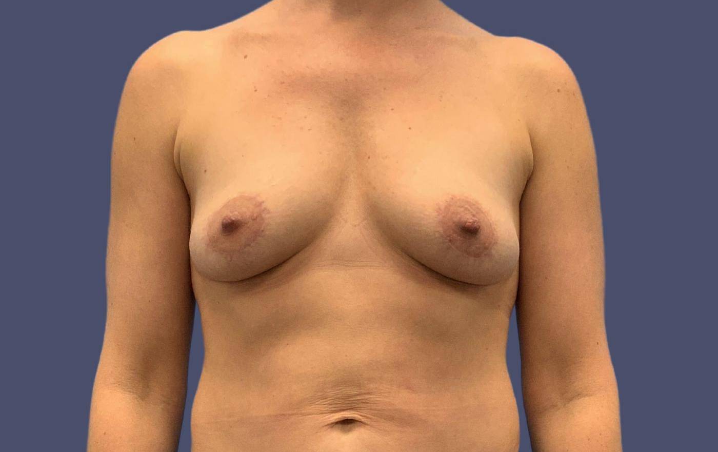 Breast Lift w/Fat Transfer 6 After