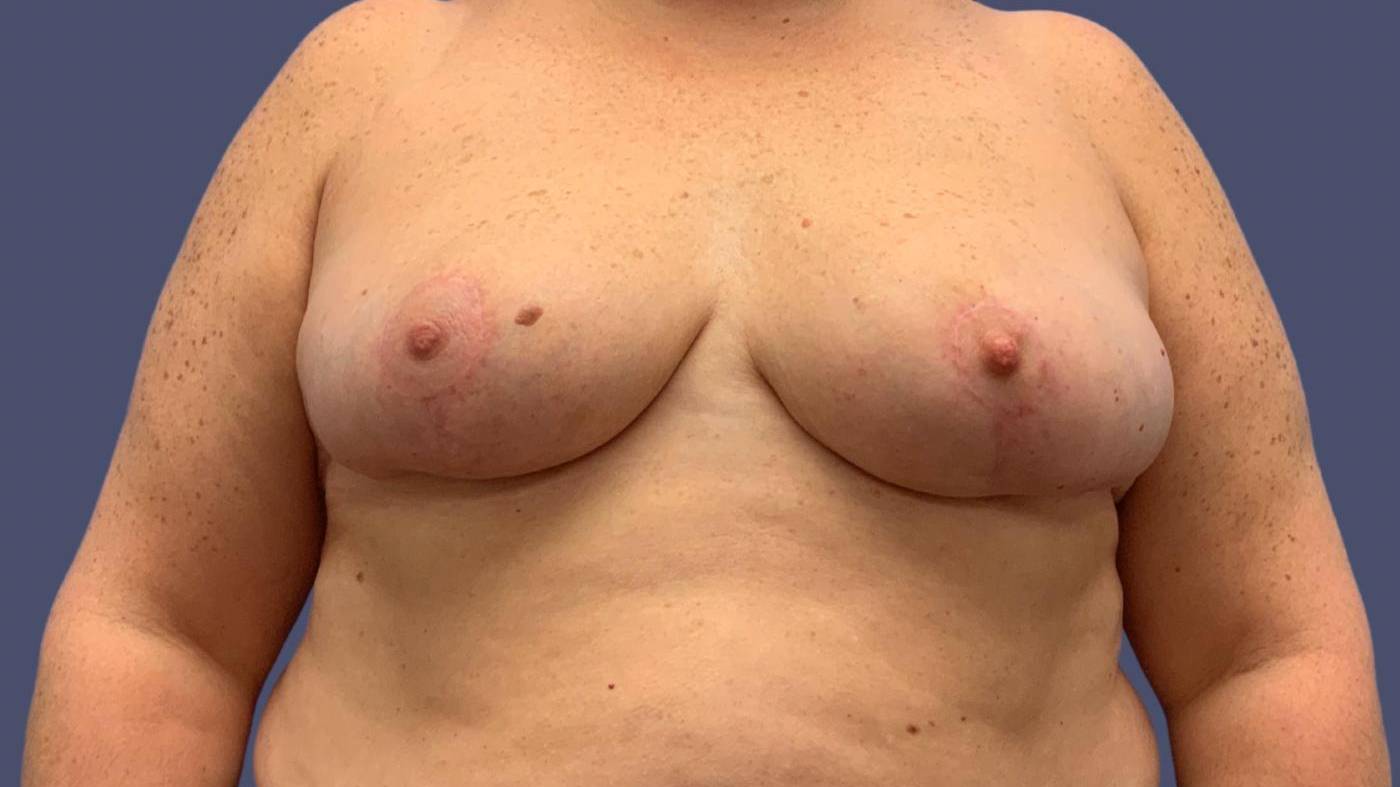 Breast Reduction 11 After