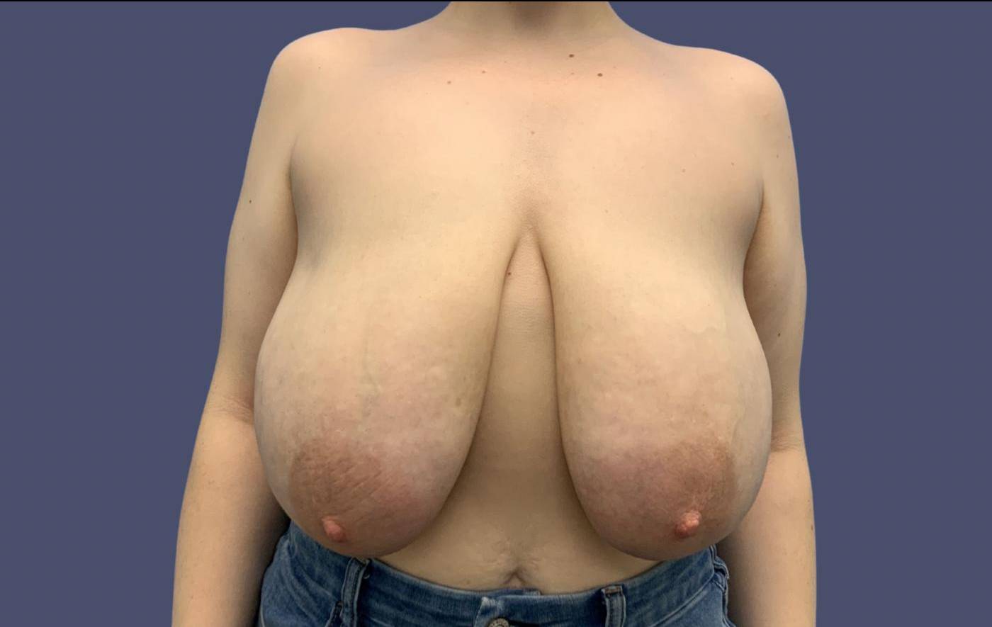 Breast Reduction 2 Before