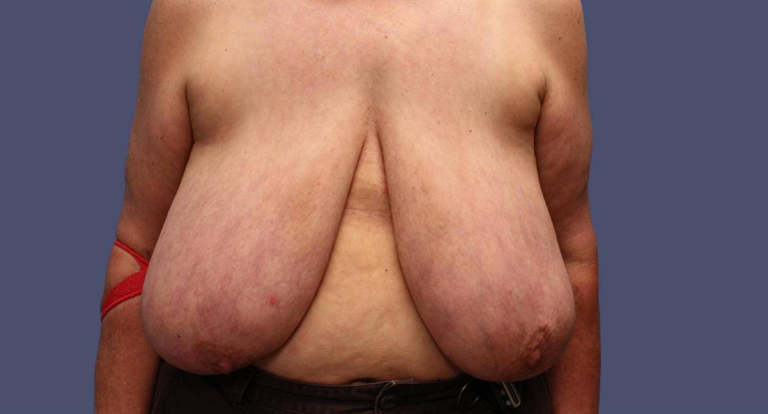 Breast Reduction 8 Before