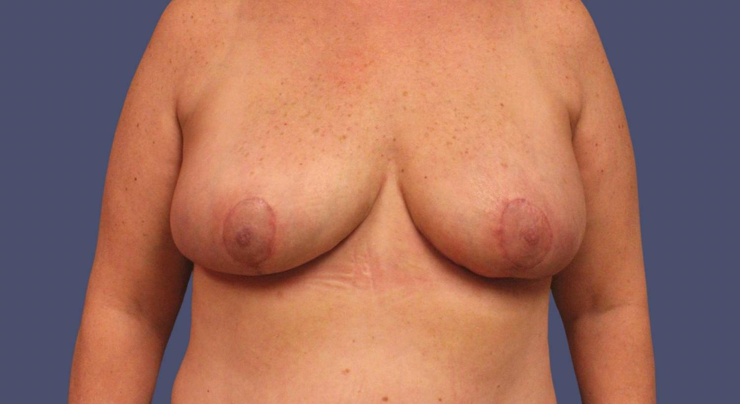 Breast Reduction 13 After