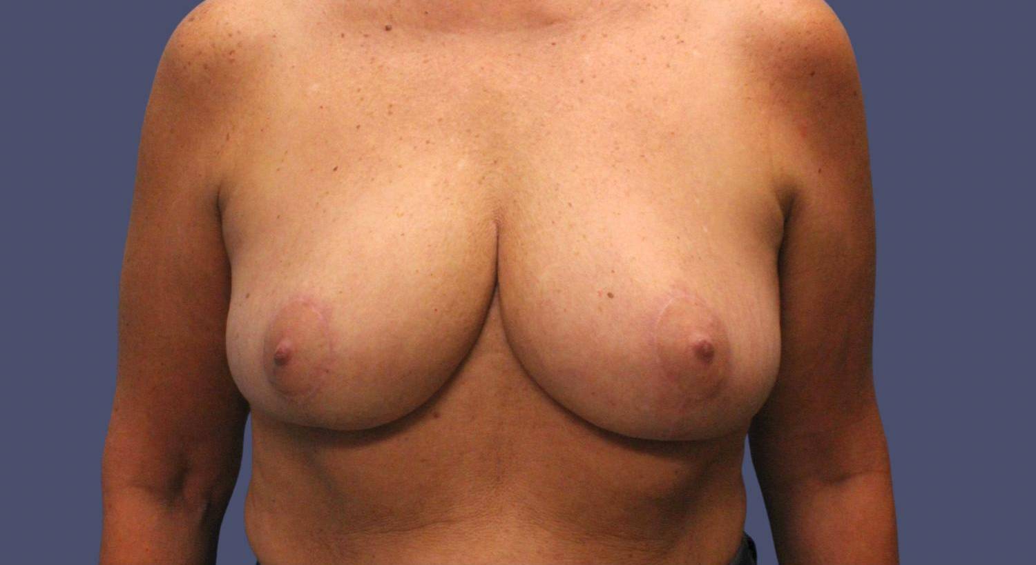 Breast Reduction 6 After