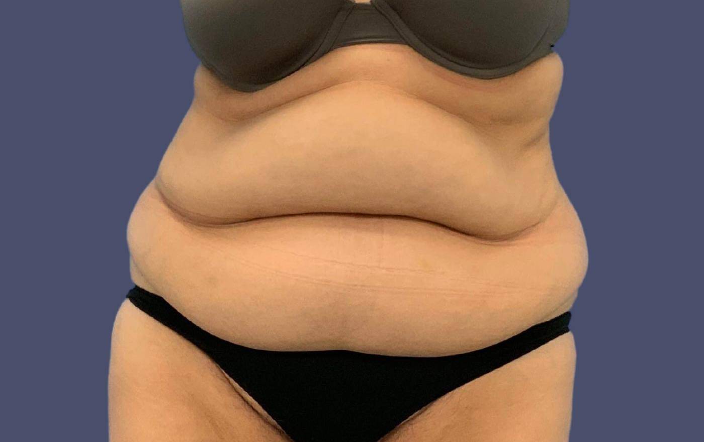 Abdominoplasty (Tummy Tuck) 35 Before