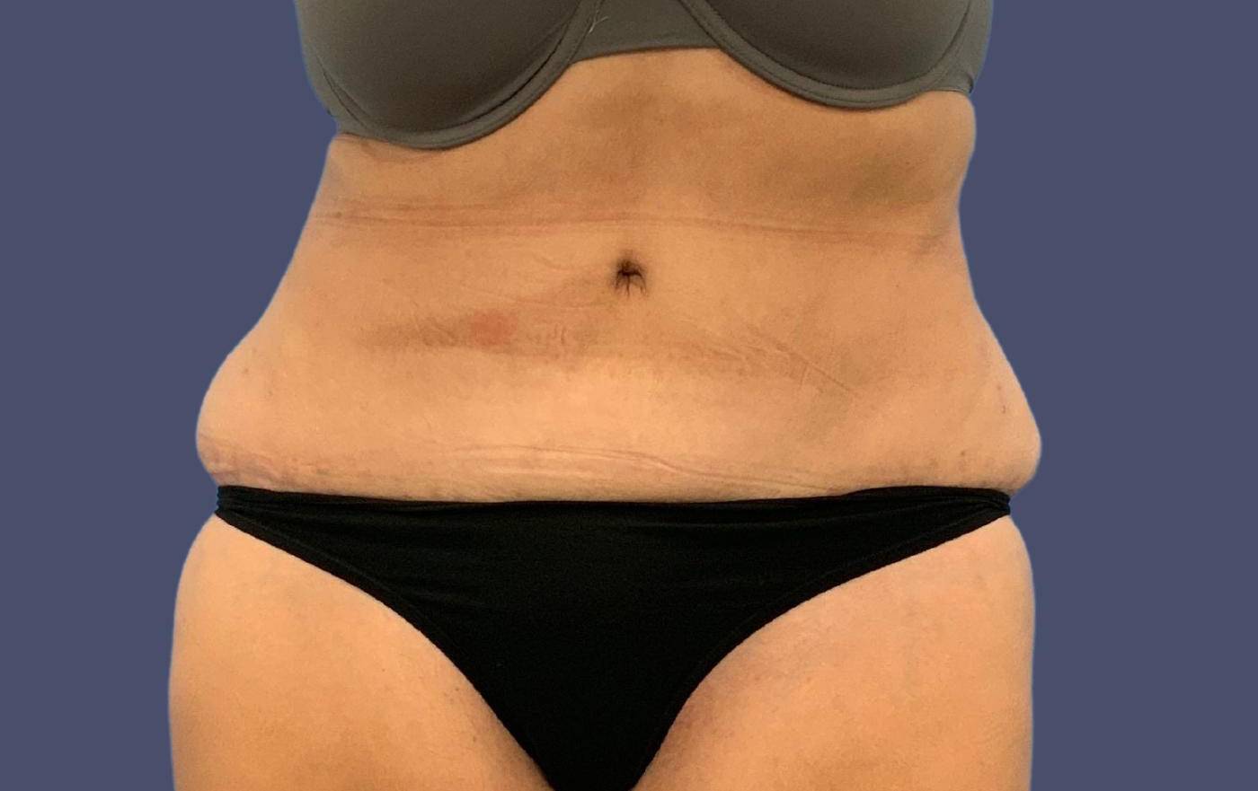 Abdominoplasty (Tummy Tuck) 35 After