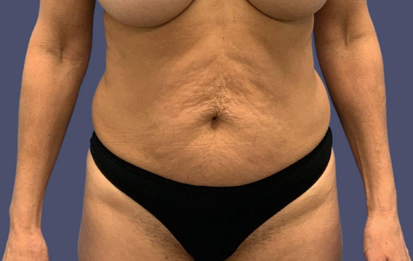 Abdominoplasty (Tummy Tuck) 12 Before