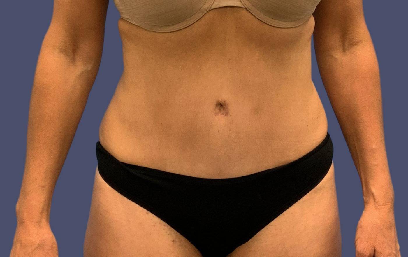 Abdominoplasty (Tummy Tuck) 12 After