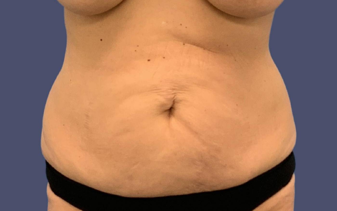 Abdominoplasty (Tummy Tuck) 18 Before