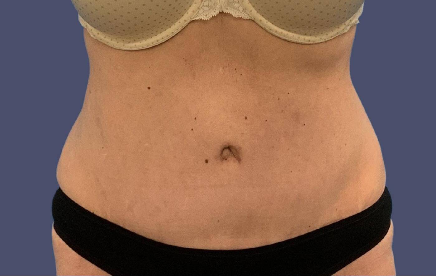 Abdominoplasty (Tummy Tuck) 18 After