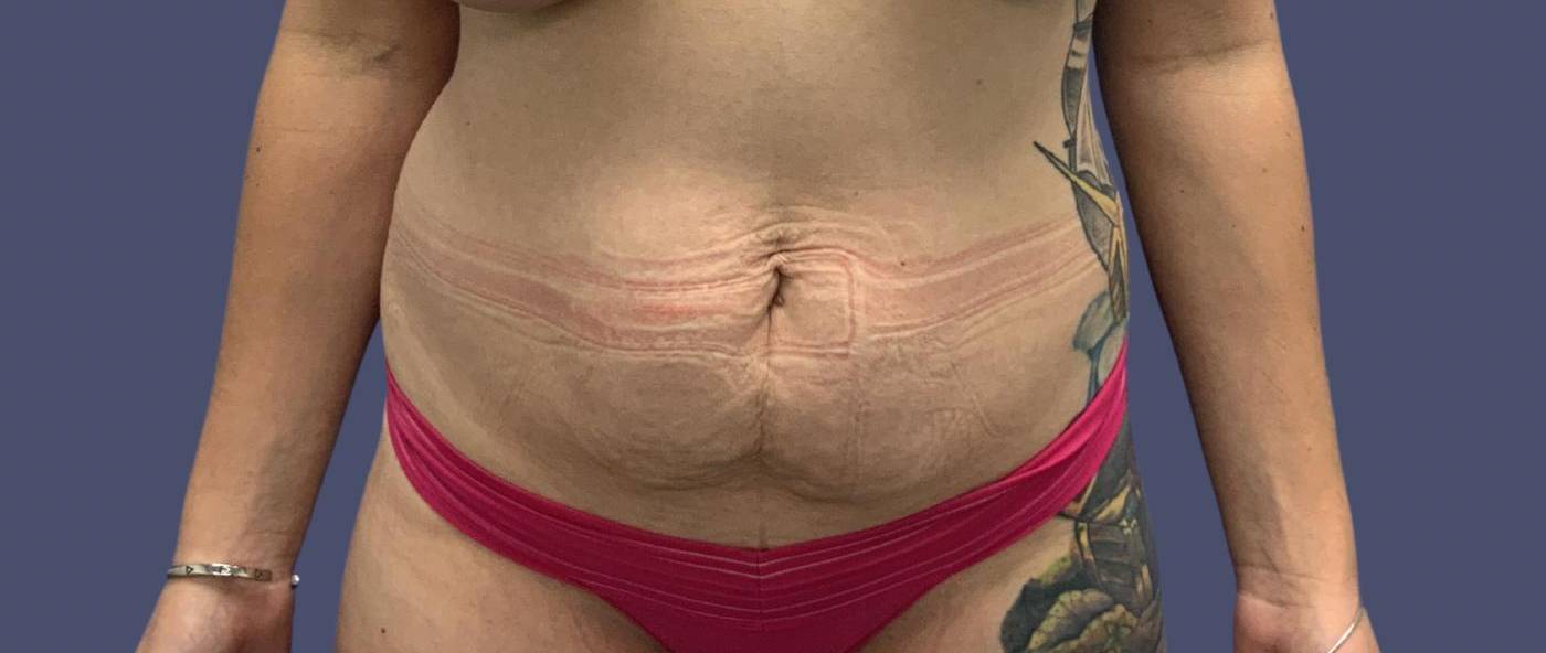 Abdominoplasty (Tummy Tuck) 35 Before