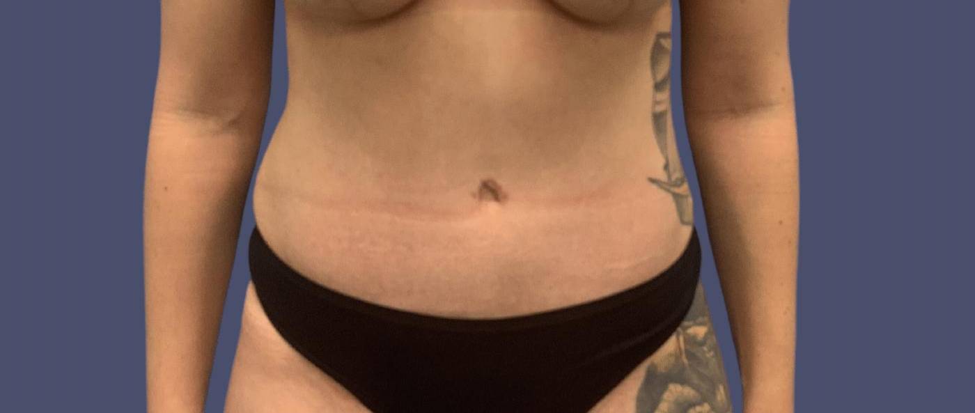 Abdominoplasty (Tummy Tuck) 37 After