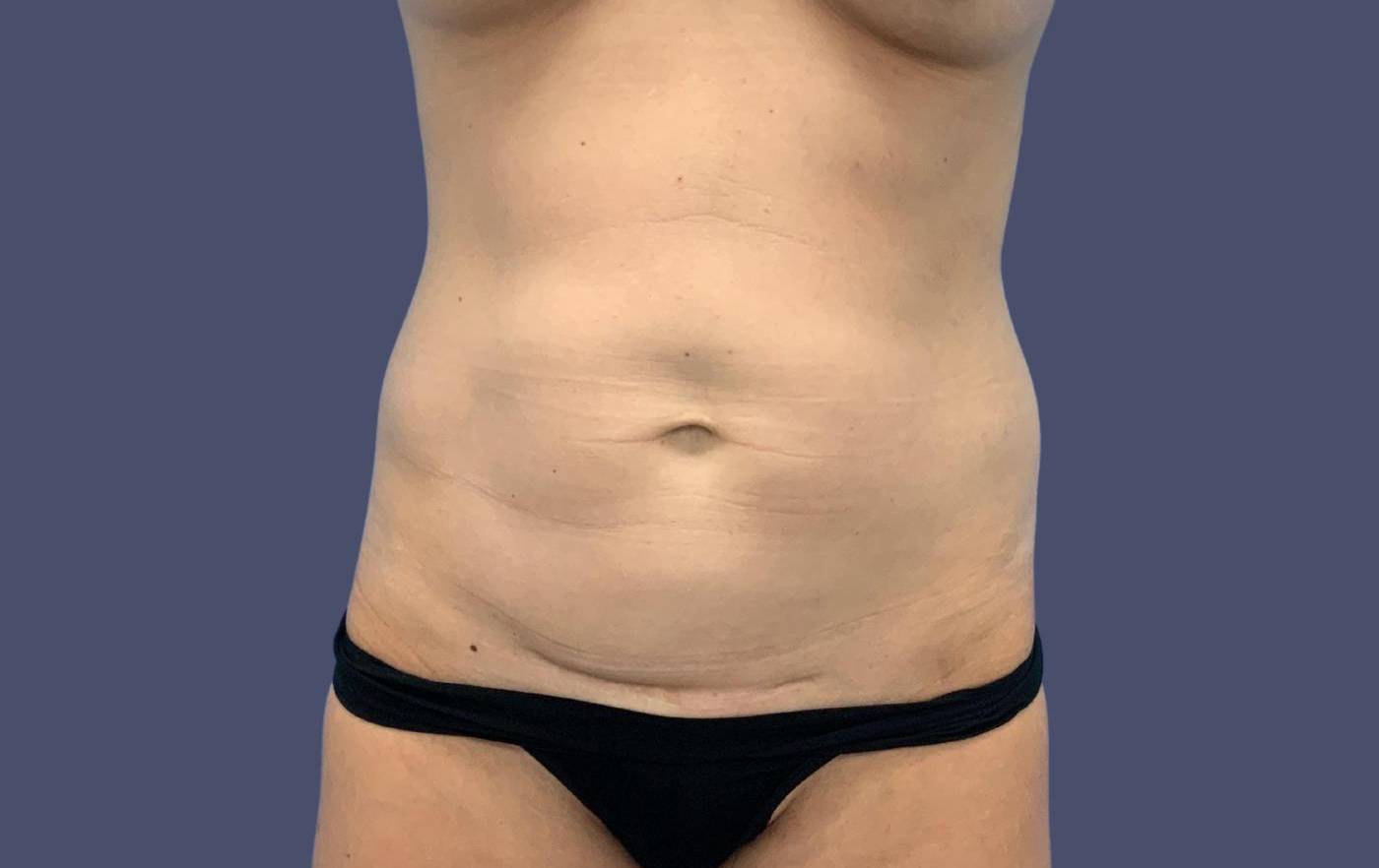 Abdominoplasty (Tummy Tuck) 14 Before