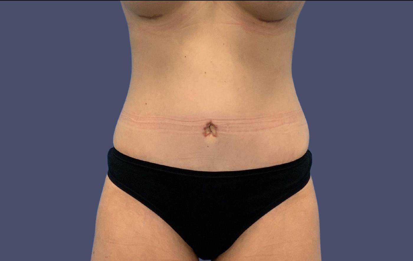 Abdominoplasty (Tummy Tuck) 13 After