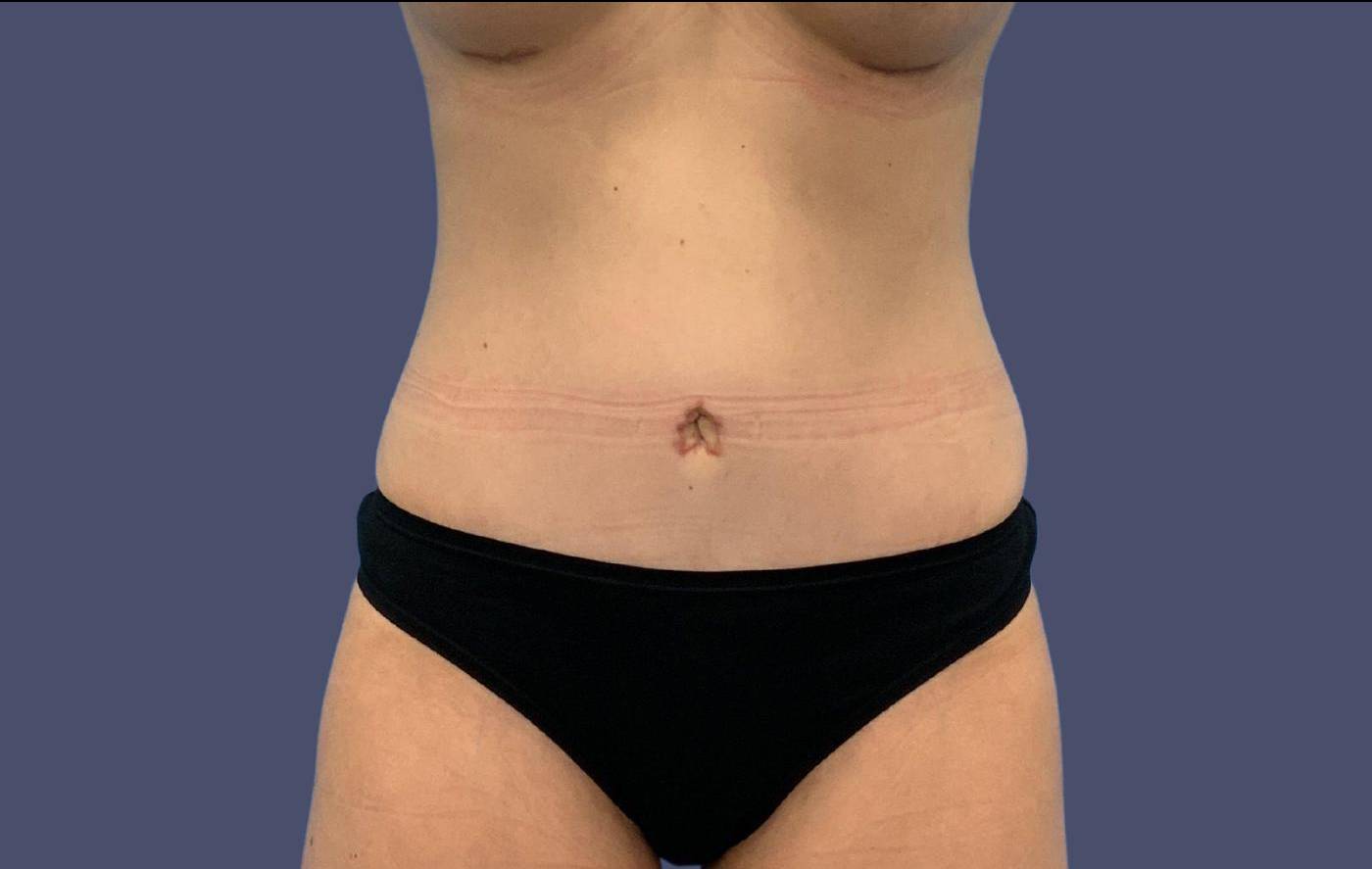 Abdominoplasty (Tummy Tuck) 14 After