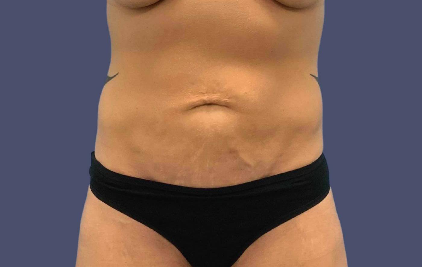 Abdominoplasty (Tummy Tuck) 30 Before