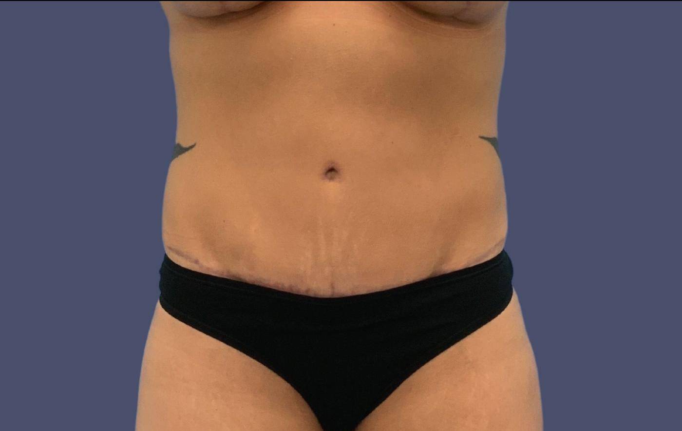 Abdominoplasty (Tummy Tuck) 27 After