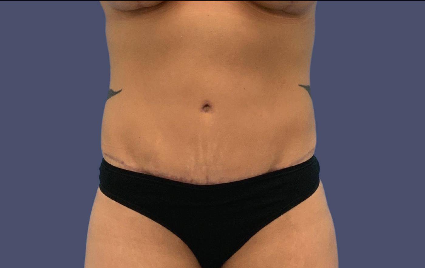 Abdominoplasty (Tummy Tuck) 30 After