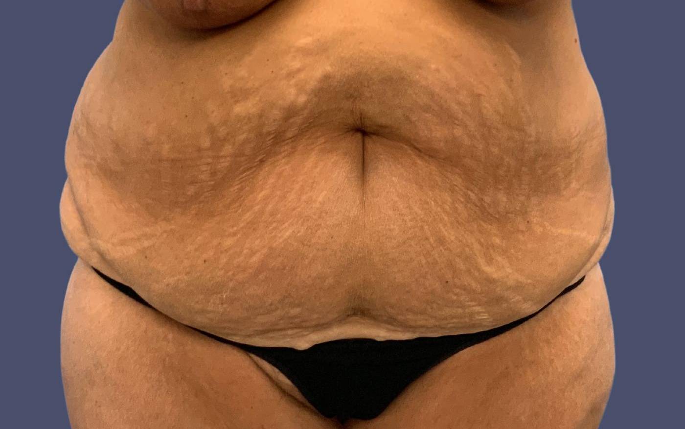 Abdominoplasty (Tummy Tuck) 39 Before