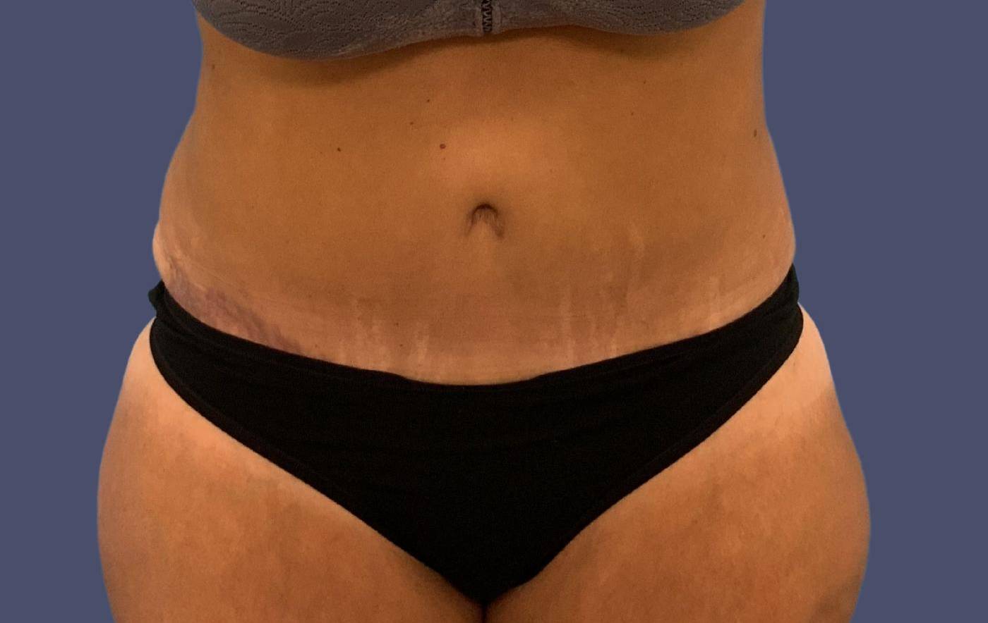 Abdominoplasty (Tummy Tuck) 37 After