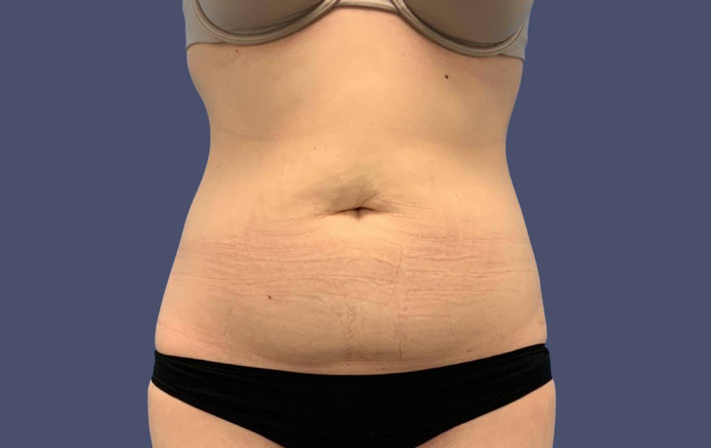 Abdominoplasty (Tummy Tuck) 11 Before