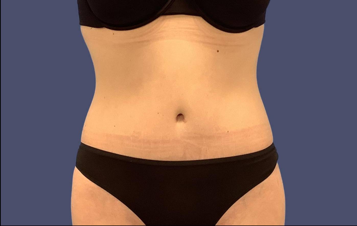 Abdominoplasty (Tummy Tuck) 10 After