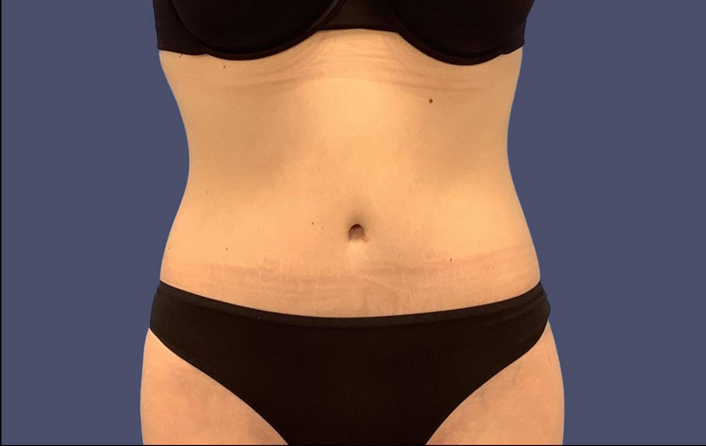 Abdominoplasty (Tummy Tuck) 11 After