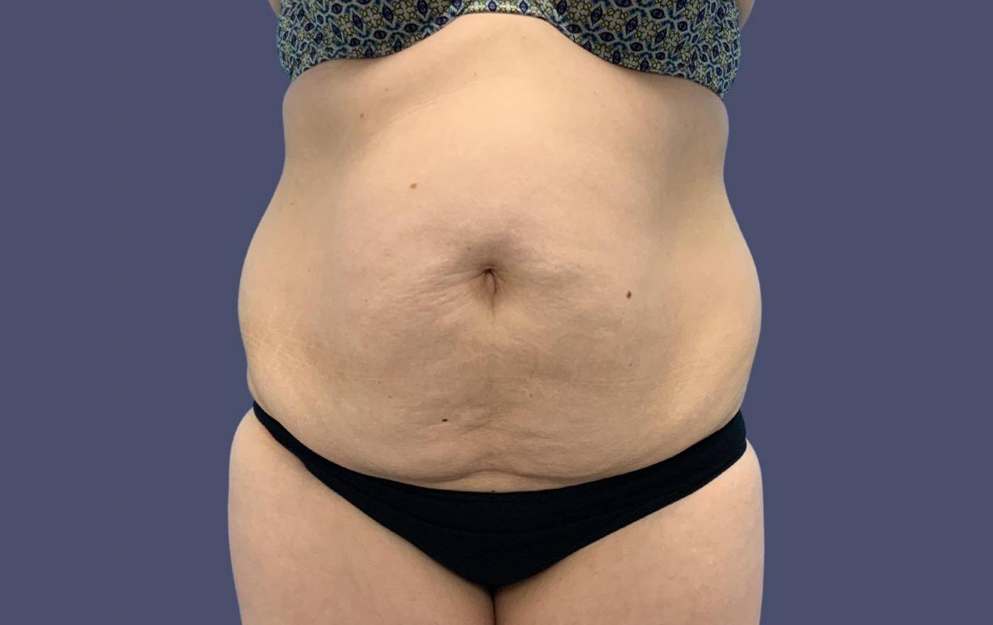 Abdominoplasty (Tummy Tuck) 9 Before