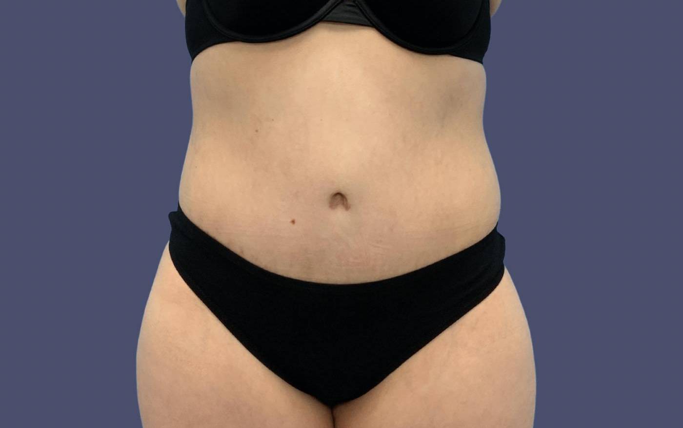 Abdominoplasty (Tummy Tuck) 9 After