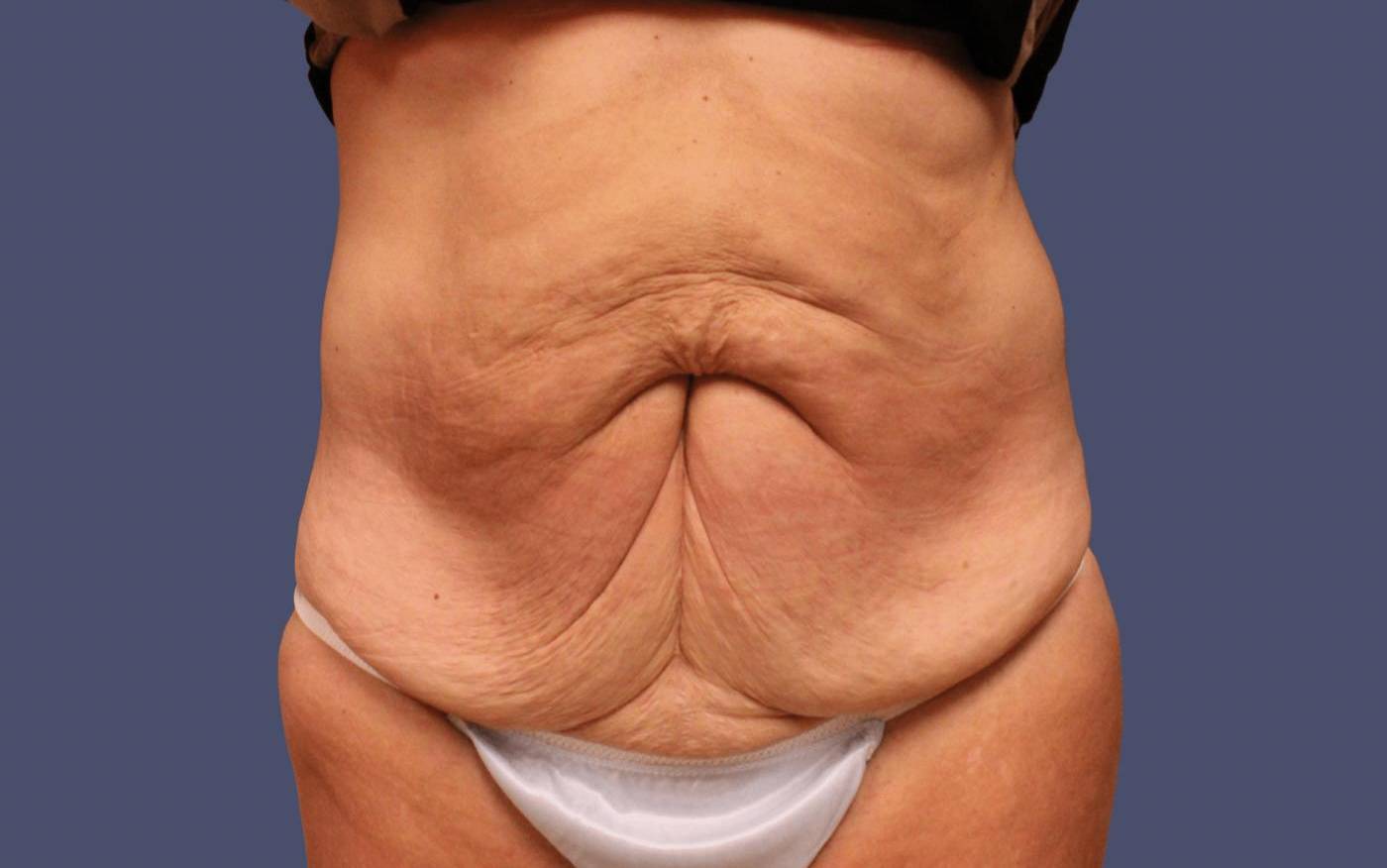 Abdominoplasty (Tummy Tuck) 34 Before