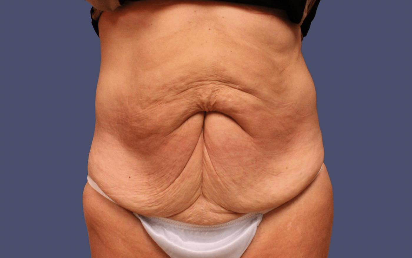 Abdominoplasty (Tummy Tuck) 36 Before