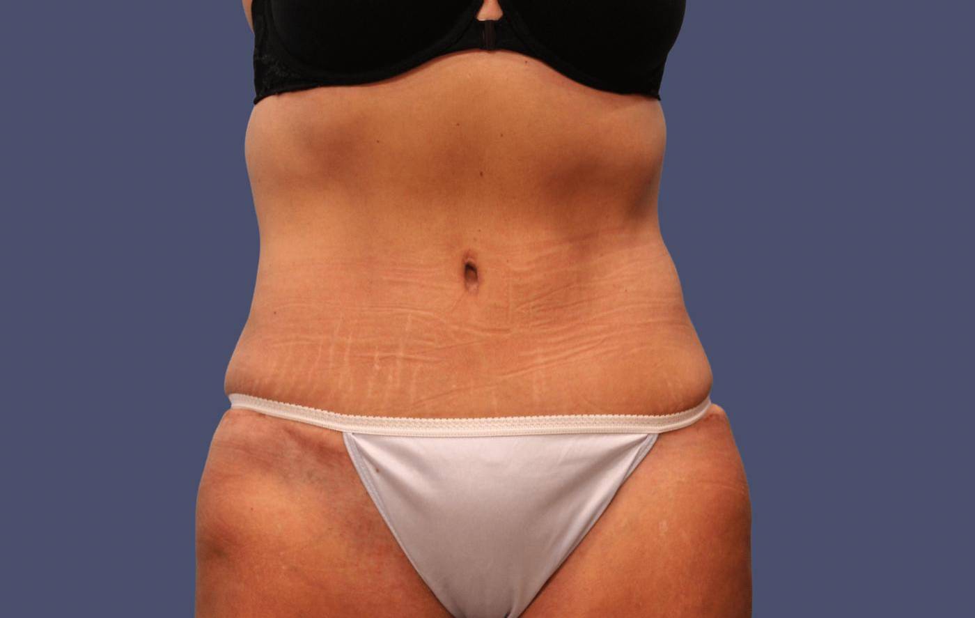 Abdominoplasty (Tummy Tuck) 34 After