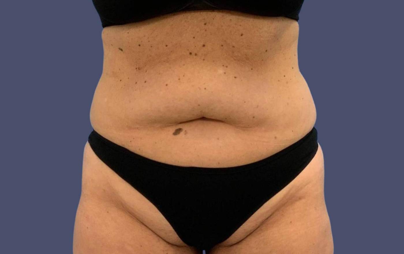 Abdominoplasty (Tummy Tuck) 2 Before