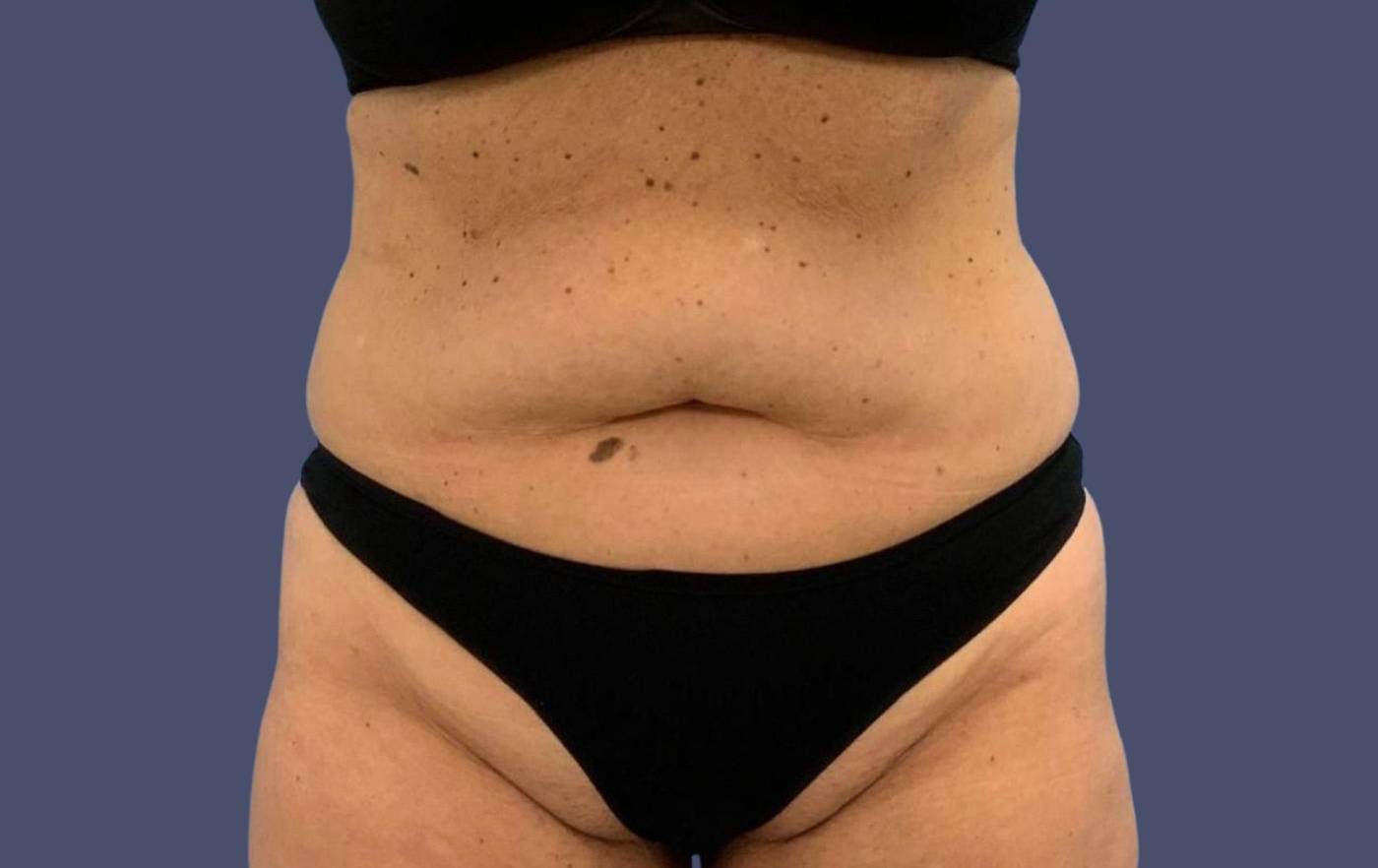 Abdominoplasty (Tummy Tuck) 3 Before