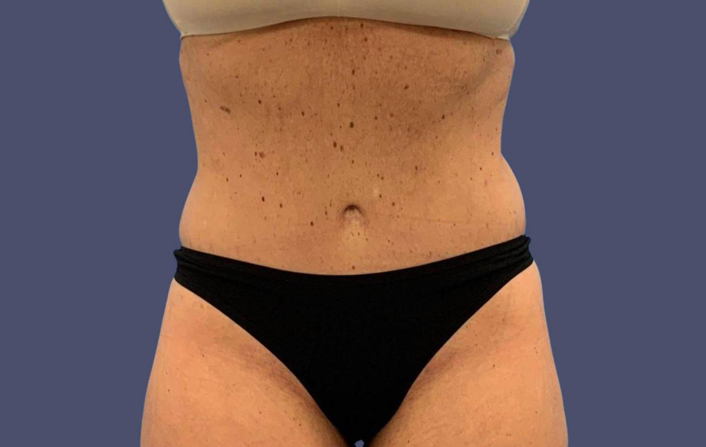 Abdominoplasty (Tummy Tuck) 3 After