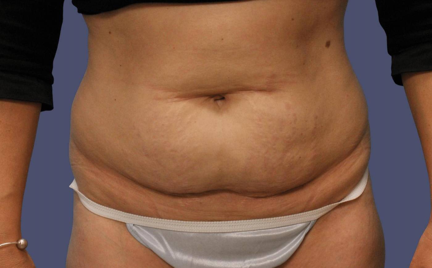Abdominoplasty (Tummy Tuck) 25 Before