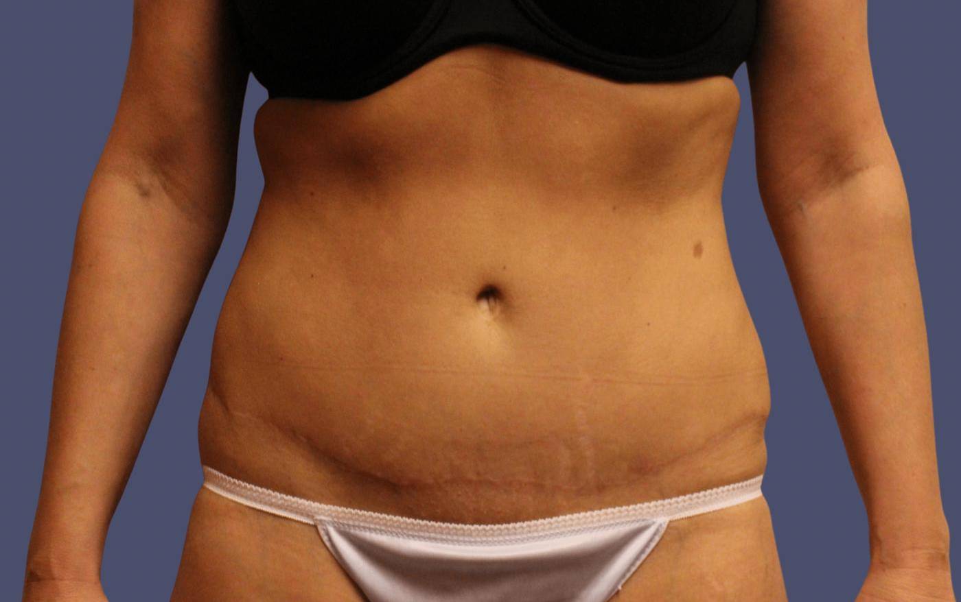 Abdominoplasty (Tummy Tuck) 28 After