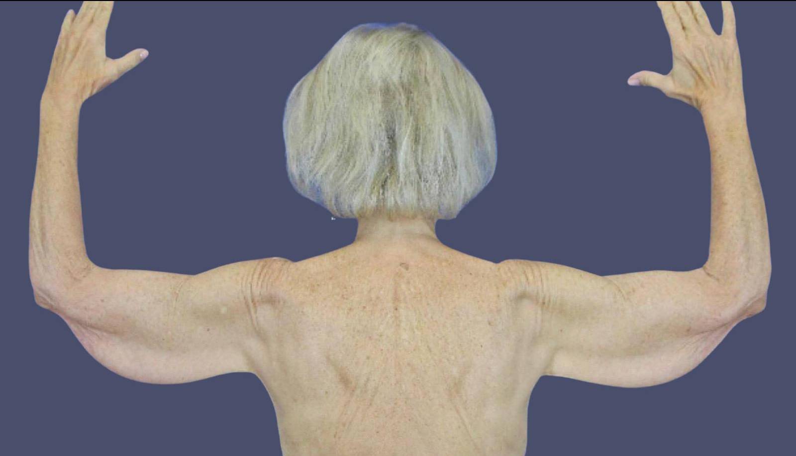 Brachioplasty (Arm Lift) 10 Before