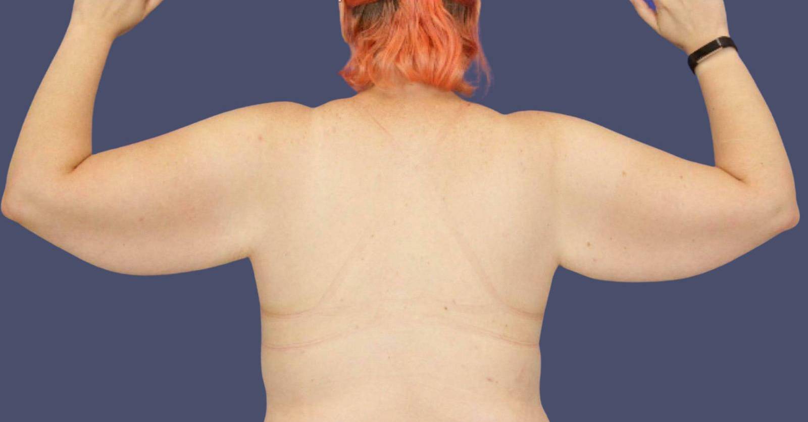 Brachioplasty (Arm Lift) 5 Before