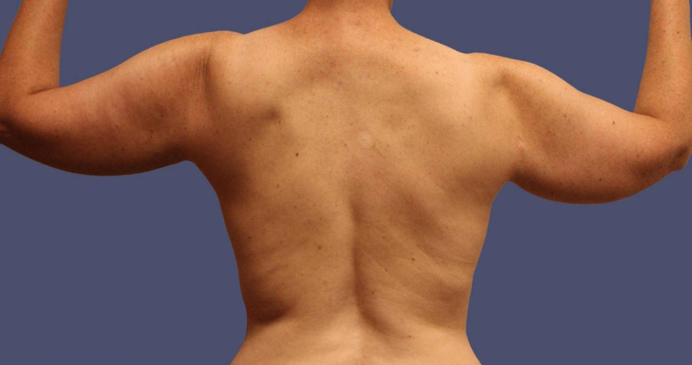 Brachioplasty (Arm Lift) 11 Before