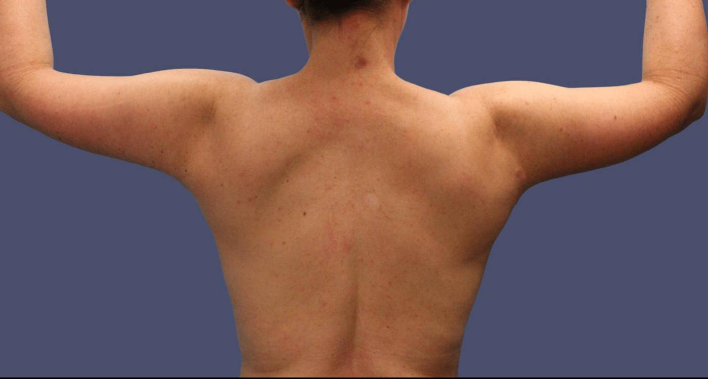 Brachioplasty (Arm Lift) 11 After